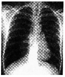 2017年安徽成人高考专升本《医学综合》考试真题1 2017年安徽成人高考专升本《医学综合》考试真题1